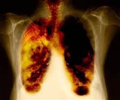 Cáncer de pulmón, cuarta causa de muerte en México